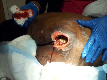 76 year old PU case 2