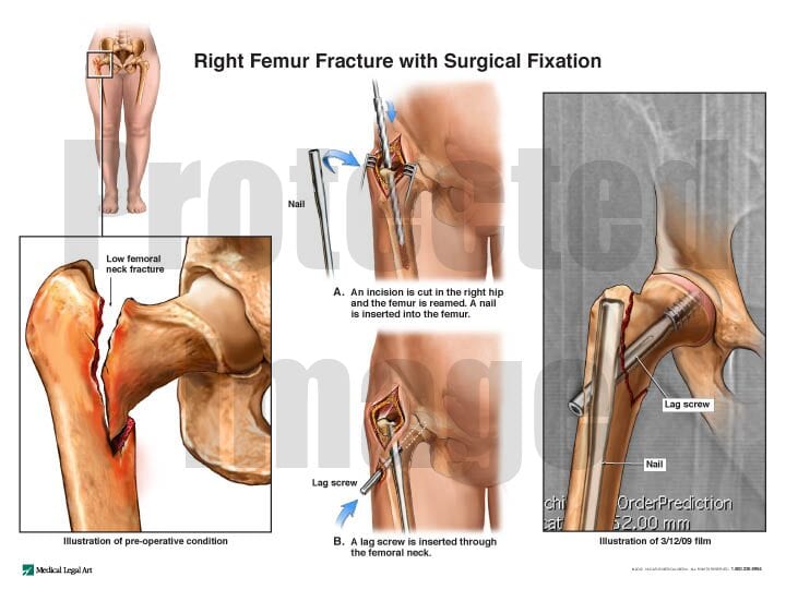 Right Femur Fracture