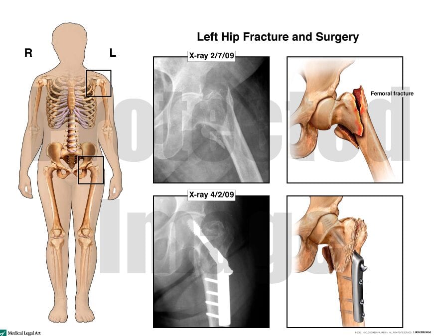 Hip Fracture