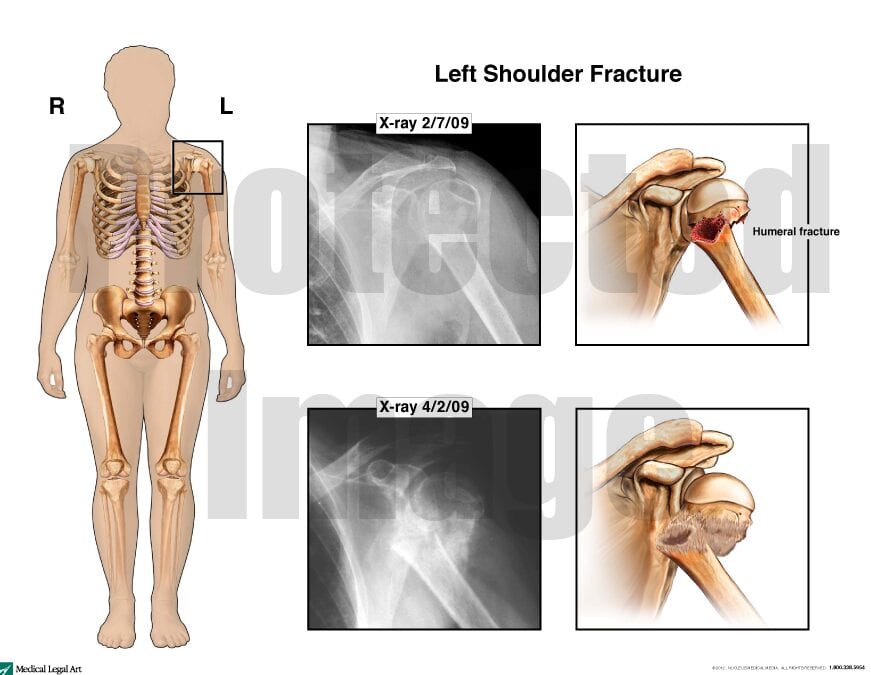 Left Fracture