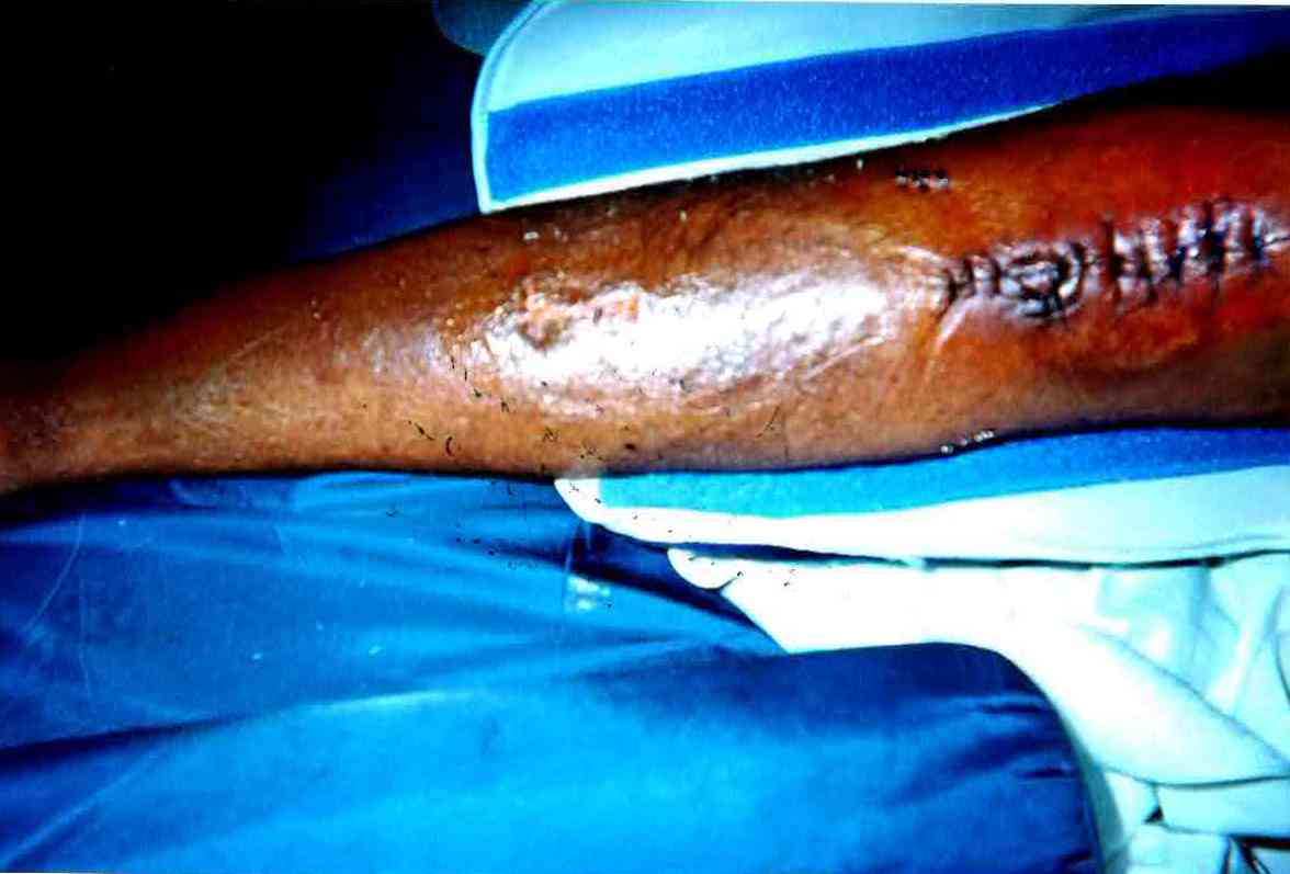 Leg Injury