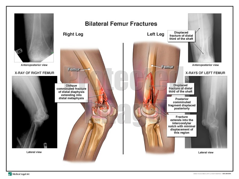 Bilateral Femur Fractures