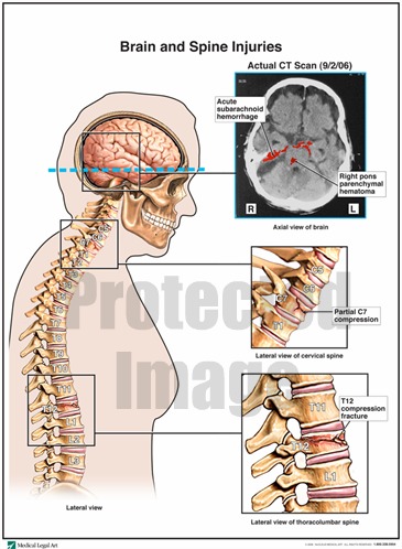 Brain and Spine Injuries