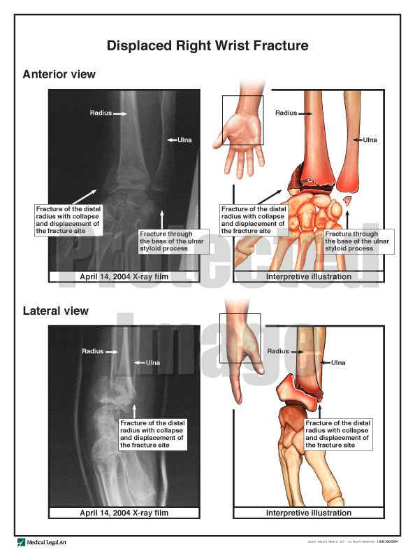 Displaced Right Wrist Fracture