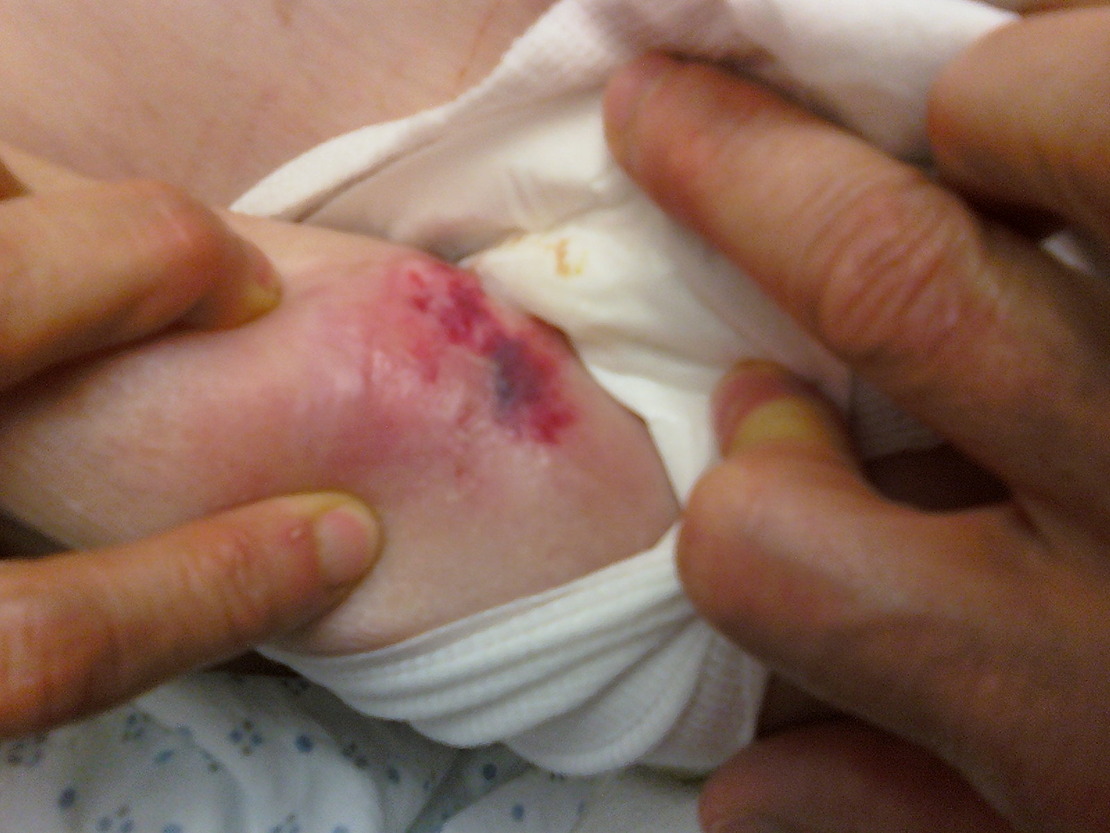 Left Arm Skin Breakdown