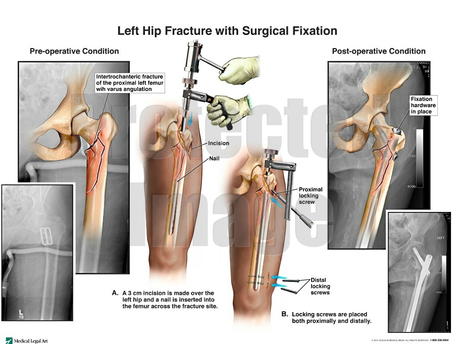Left Hip Fracture with Surgical Fixation