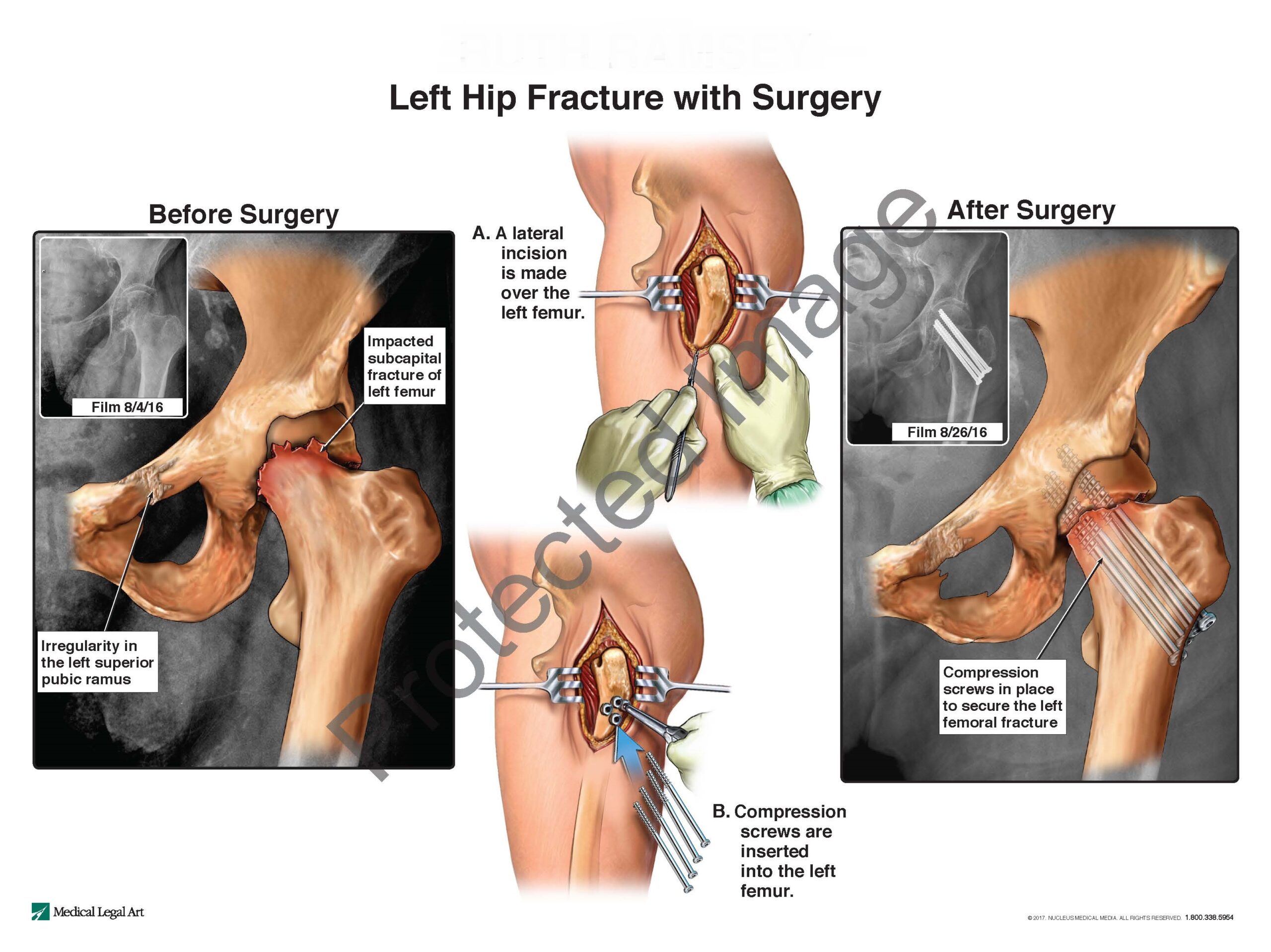 Left Hip Fracture