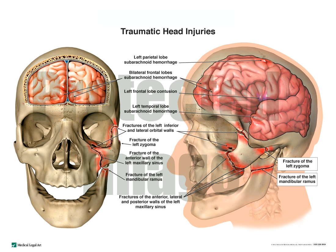 Traumatic Head Injuries