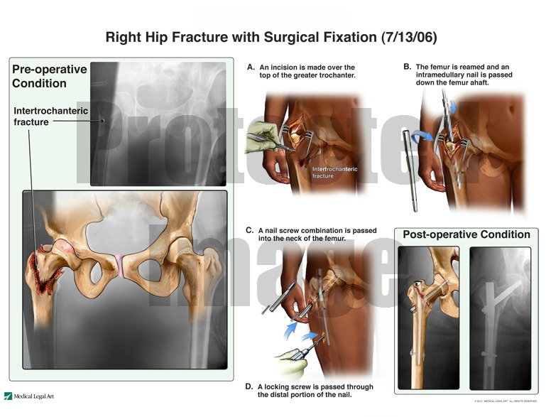 Right Hip Fracture