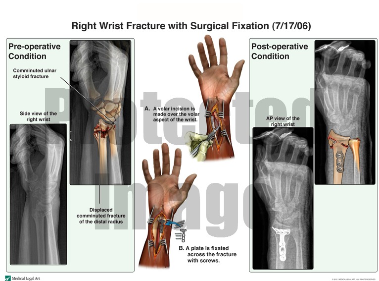 Right Wrist Fracture