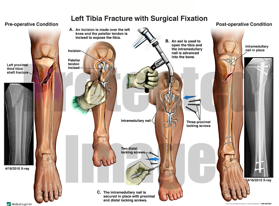 Left Tibia Fracture with Surgical Fixation