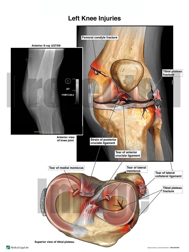 Left Knee Injuries