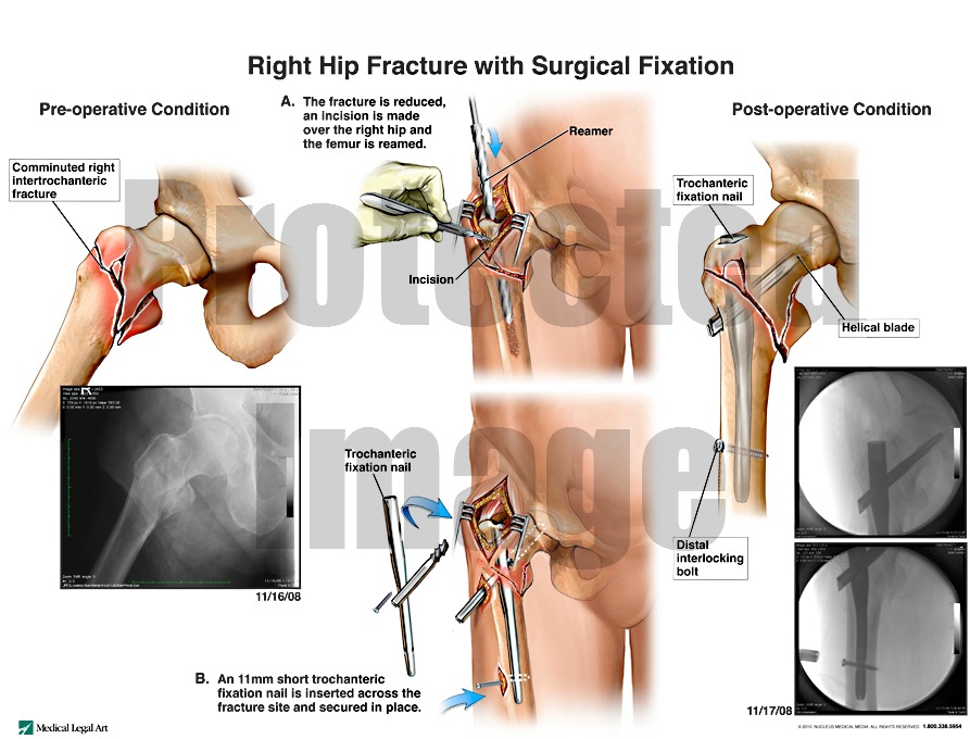 Right Hip Fracture with Surgical Fixation
