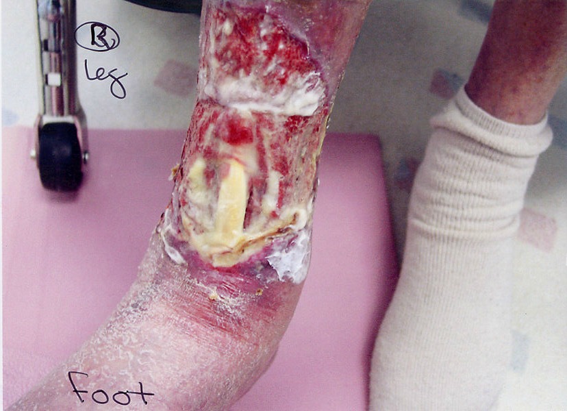 Right Leg Pressure Ulcer