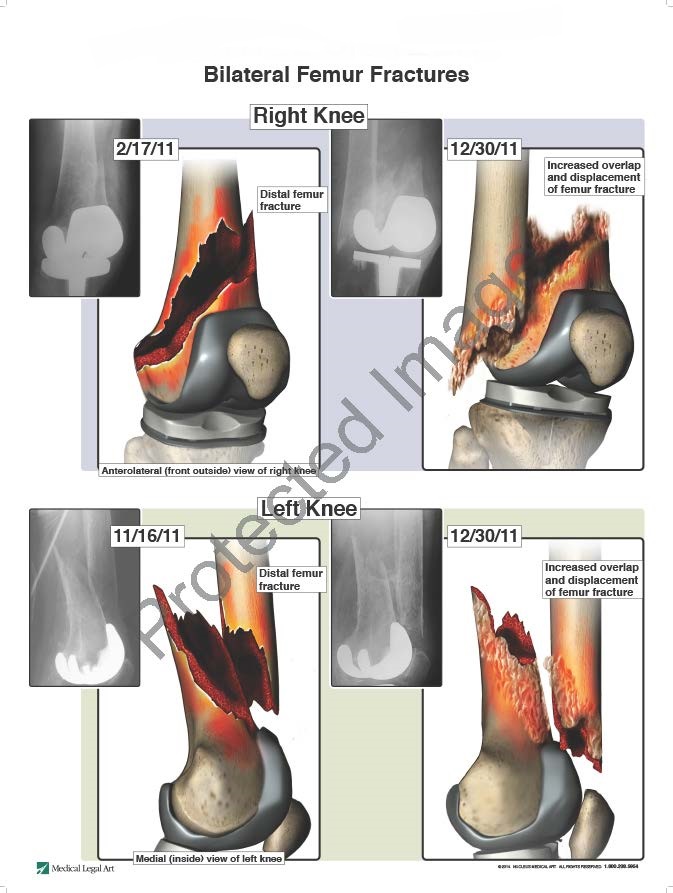 Bilateral Femur Fractures