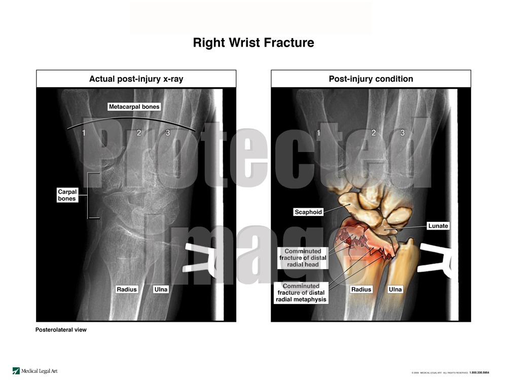 Right Wrist Fracture