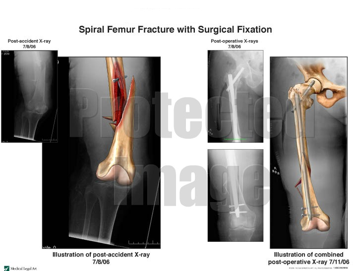 Spiral Femur Fracture with Internal Fixation