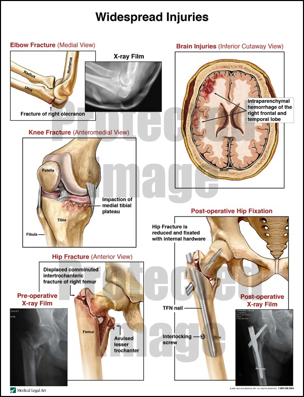 Hip Fracture; Knee Fracture; Elbow Fracture; Brain Injury