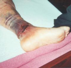 See the ankle after surgery.