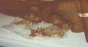 See a photo of the pressure ulcers (bed sores, pressure sores, decubitus ulcers)